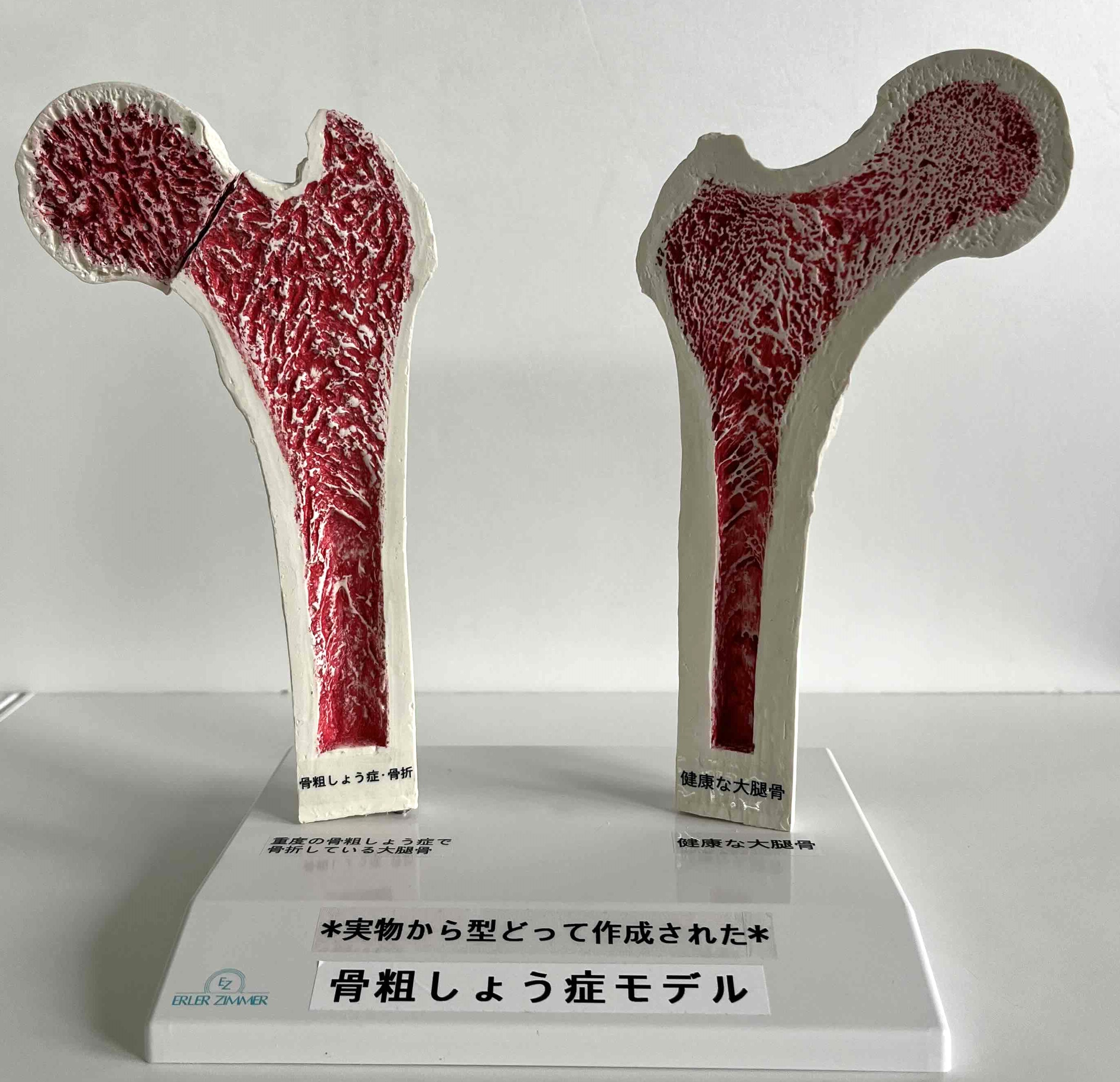 骨粗しょう症モデル | 公益財団法人 北海道健康づくり財団